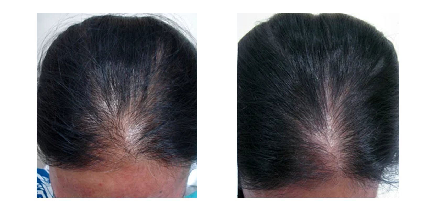 Post Treatment