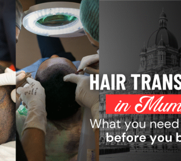 FUE hair transplant in Mumbai surgery procedure