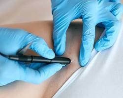 Bikini line laser hair reduction