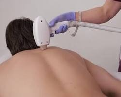 Full body laser hair reduction package