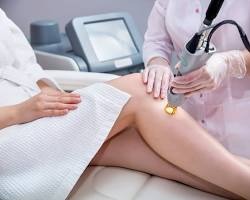 Full legs laser hair reduction