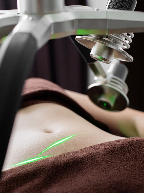 Stomach & back laser hair reduction