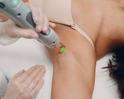 Underarm laser hair reduction